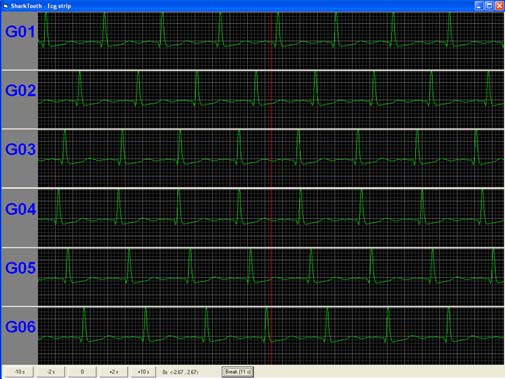 Sharktooth ECG trace